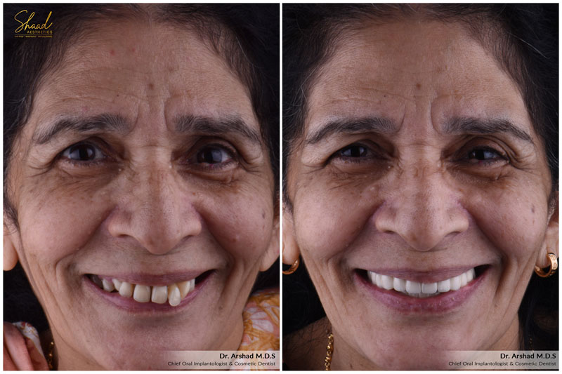 Anti-aging dentistry before after image
