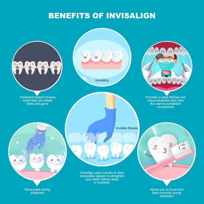 Benefits of invisalign