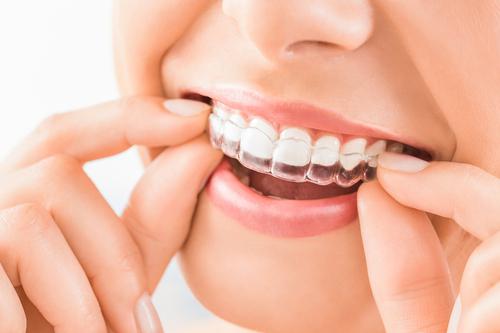 Invisalign Treatment in Forest Hills, Queens – VIP Dental care