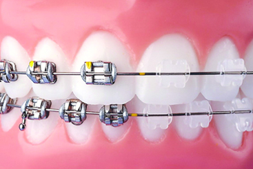 Conventional braces