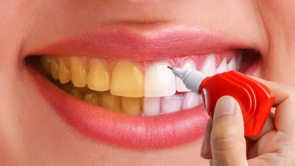Dental bleaching for teeth whitening