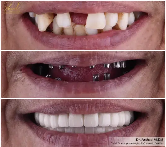 dental implants before- after dental treatment