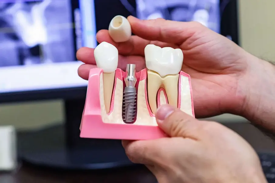 Structure of the dental implants
