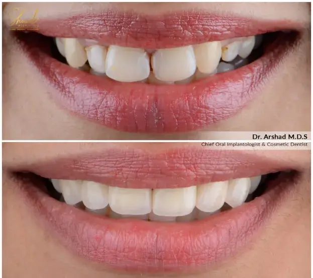 Smile correction before-after cosmetic dentistry treament
