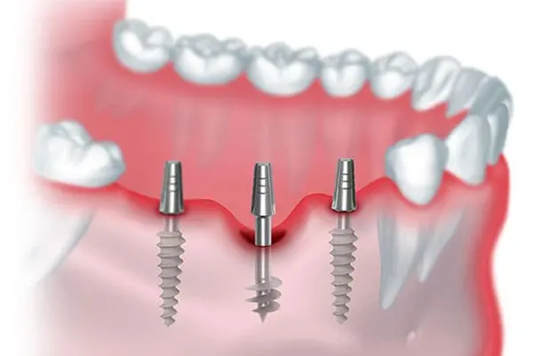 Strategic dental implants