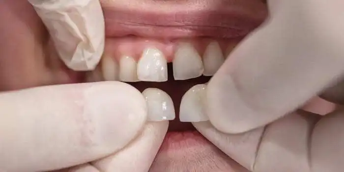 teeth with veneers in Coimbatore